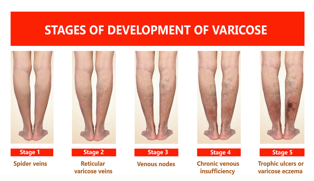Stages of Varikosis - Dr. de Nitto